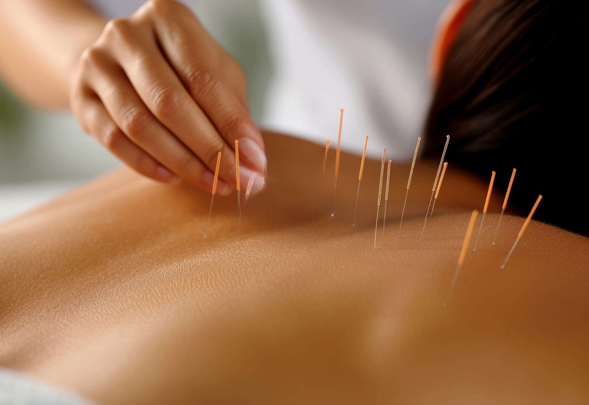 Acupuncture / Dry Needling Therapy